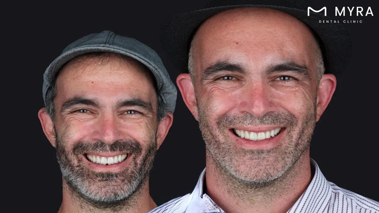 How much does dental implants cost in the UK_.webp